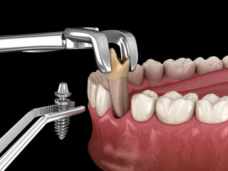 Tooth extraction and implantation, complex immediate surgery. Dental 3D illustration