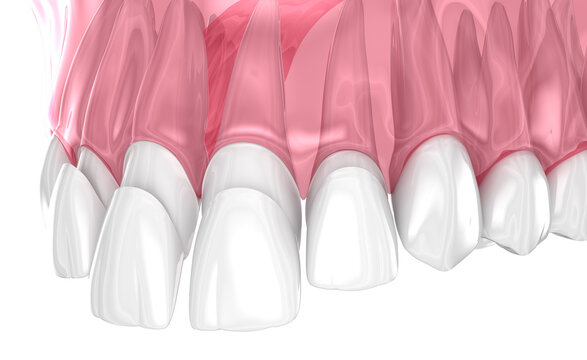 Dental veneer placement over central and lateral incisor. Medically accurate tooth 3D illustration