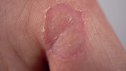 Male hand with callus on the finger close-up. Wart on hand. The skin of the hands lacks vitamins. Macro.