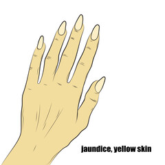 Jaundice, yellowish skin caused by the accumulation of bilirubin in the blood.