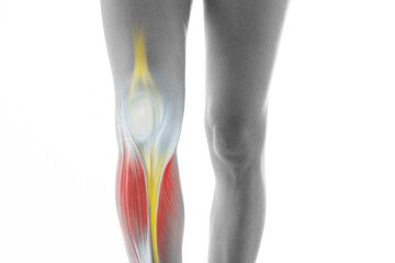 Knee pain, meniscus inflamed, human leg medically accurate representation of an arthritic knee...