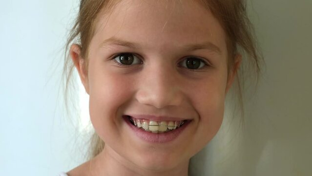 Kid girl smiling with orthodontic plate. Removable plates and simple treatment. Teeth alignment, retainer orthodontic correction