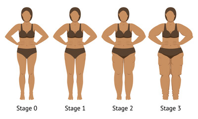 Women's body in different stages of Lipedema