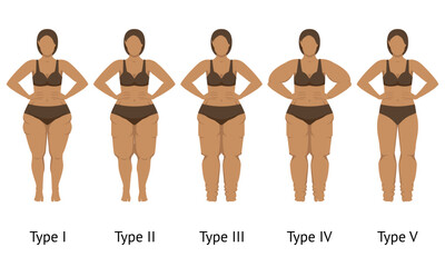 Women's body in different types of Lipedema - 576303065