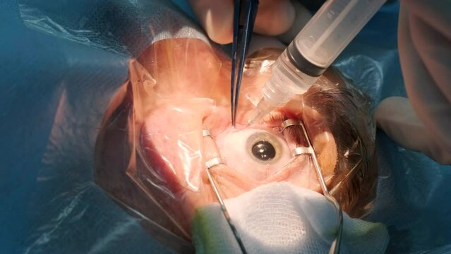 Eye surgery, vitreoretinal. Vitrectomy surgery.
