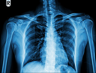X-ray images of the shoulder show future right shoulder