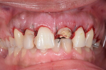 Dentistry patient with esthetical condition in central incisor because of dental decay and bad hygiene. Broken lost teeth with postsurgical suture thread and bloody gingival gum. - obrazy, fototapety, plakaty
