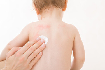 Mother fingers applying white medical ointment on infant bare back isolated on light gray...