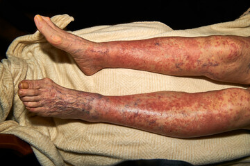 elderly woman over eighty years old shows her legs with areas of reddened skin from acenocoumarol...