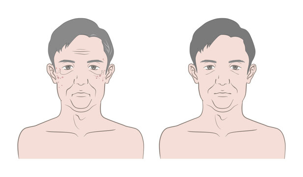 60代くらいの中高年男性の顔の老化、変化、ビフォーアフターのイメージイラスト