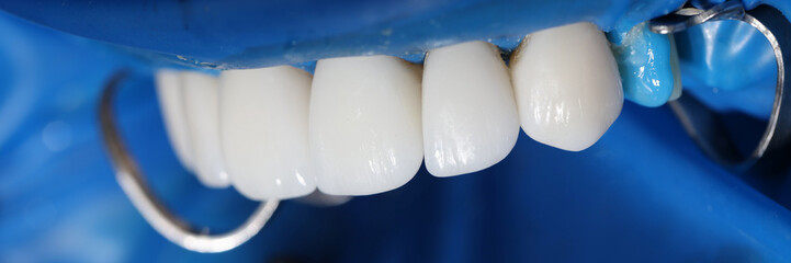 Fototapeta na wymiar Installation of veneers and dental implants in clinic closeup