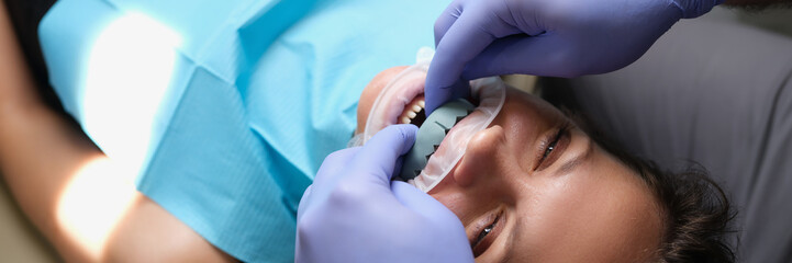 Woman with dental cast veneer on upper jaw in dentistry © H_Ko