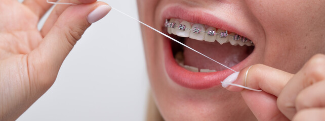Caucasian woman cleaning her teeth with braces using dental floss. Cropped portrait. 