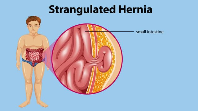 Animation of Strangulated Hernia with Explanation