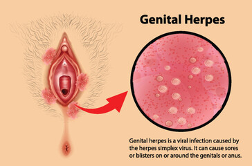Genital Herpes infographic with explanation - obrazy, fototapety, plakaty