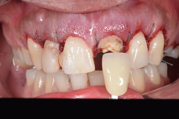 Dental color selection with a shade tab, aesthetic condition in central incisor because of dental...