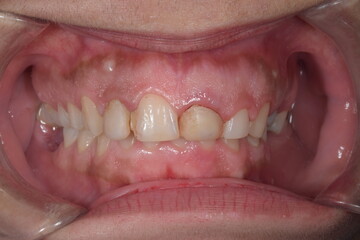 Dentistry aesthetic condition with oral disease in the central incisor because of dental decay, a bad resin composite restauration and gingiva gum misaligned with periodontal inflammatory bleeding. 
