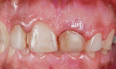 Dentistry aesthetic condition with oral disease in the central incisor because of dental decay, a...