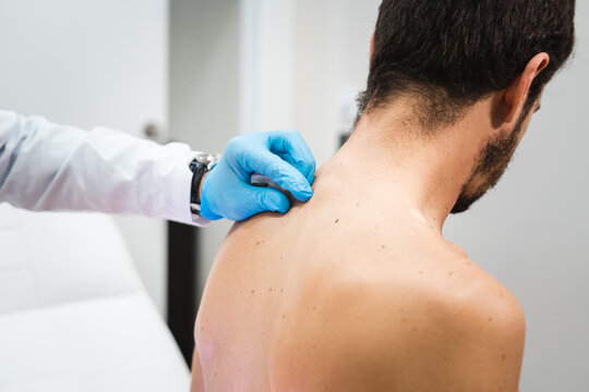 Espalda de paciente siendo examinada por dermat&oacute;logo con guantes para observaci&oacute;n de lunares