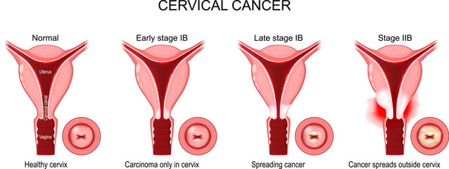 Cervical Cancer. Stages of a Carcinoma of Cervix.