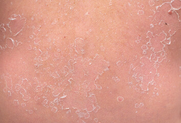 Fototapeta premium Sunburn, close-up of human skin. Flaky skin from allergies, peeling or eczema. Dry skin in need of treatment and hydration.