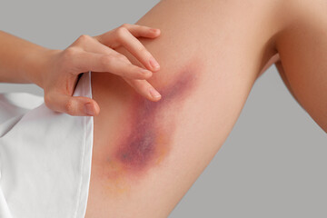 Young woman with bruised leg on grey background, closeup
