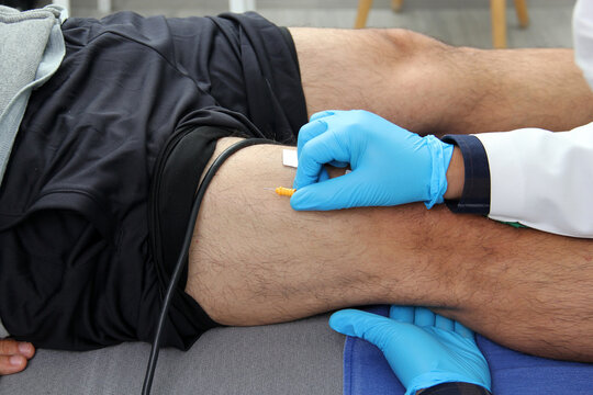 Electromyography EMG and Somatosensory Evoked Potential PEV of lower extremities, neurophysiological test applies electrical stimuli near the nerves to explore the rectus femoris muscle