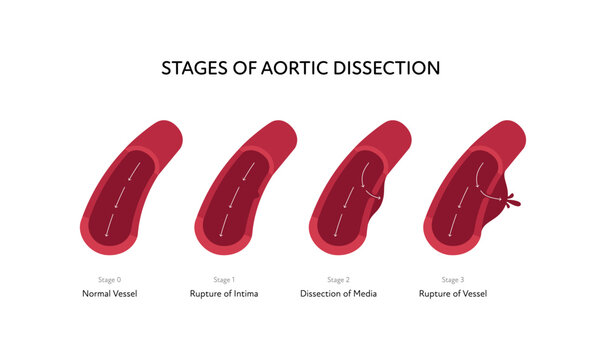 Blood vessel anatomy disease infographic chart. Vector color flat illustration. Aortic cross section with stages of dissection anatomical diagram. Design for healthcare, cardiology, education.