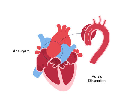 Heart anatomy disease infographic chart. Vector color flat illustration. Inner organ cross section with aortic aneurism dissection anatomical diagram. Design for healthcare, cardiology, education.