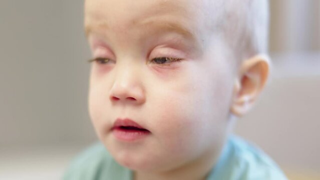 baby child face with conjunctivitis symptoms eyes red color swelling conjunctiva eyelids. increased tear production, irritation around eye. kids eyes with pink eye disease illness after flu cold
