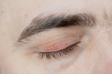Peeling and swelling on the eyelid of the human eye.