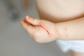 Severe wound on the child's hand. The animal bit and scratched a small child by the hand