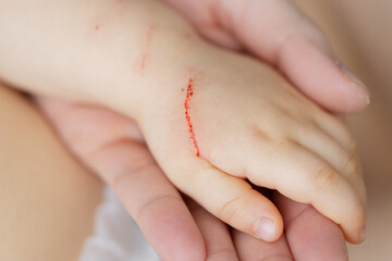 Severe wound on the child's hand. The animal bit and scratched a small child by the hand