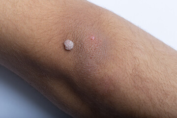 close up of a body, Visible Wart on Arm, Verruca on Arm in Close-up