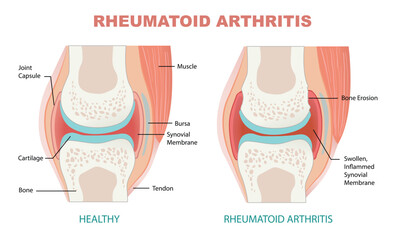comparison between rheumatoid arthritis and healthy joint - obrazy, fototapety, plakaty