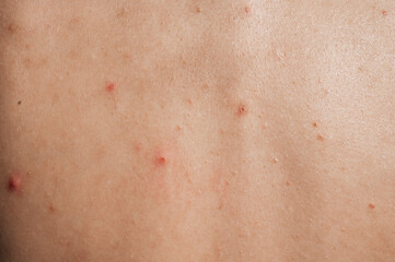 Fototapeta premium Close-up of the skin of a young girl with problems. Pimples, acne, pores, scars. Natural skin without filters