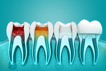 Dental implant procedure. 3d illustration