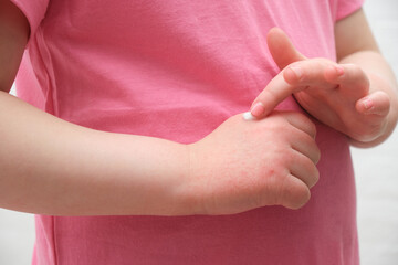 The child scratches atopic skin. Dermatitis, diathesis, allergy on the child's body.irritation and pruritus.