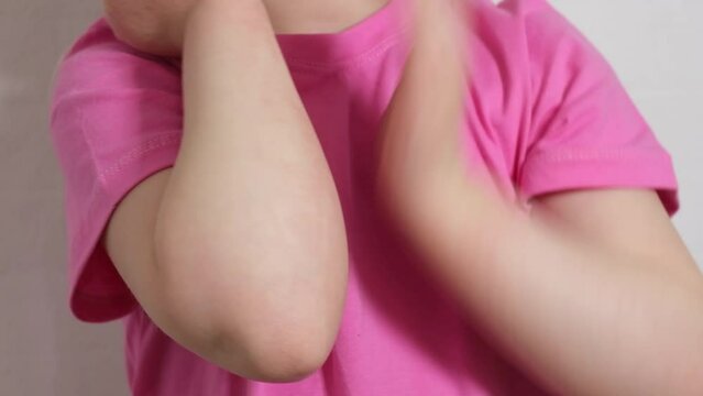 atopic dermatitis concept, a girl scratches the skin of her hands covered with a rash, redness of the skin, an allergy in a child 4K