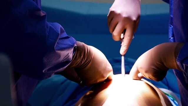 4K Real preparation of robotic surgery. Doctor and nurse inserting robotic arms into abdomen. Medical operation involving robot. Minimally invasive robotic.  