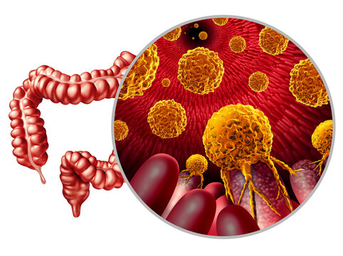 Colon cancer growth or colorectal malignant tumor concept as a medical illustration of a large intestine with a Metastatic Carcinogenic disease of the digestive system