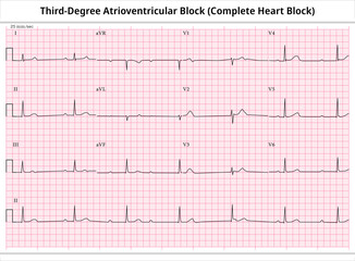 Third Degree Atrioventricular Block - ECG Paper 12 Lead - Electrocardiogram - Vector Medical Illustration - obrazy, fototapety, plakaty