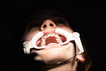 Close up of girl with brackets receiving dental braces treatment in clinic