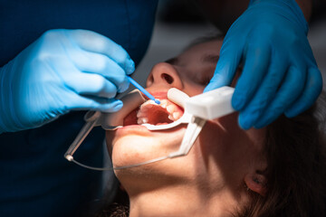 Dentist appointment at a dental clinic, placing braces locks on the teeth and pulling the archwire to fix it