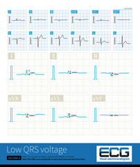 The QRS wave amplitude of each limb lead is less than 5mm, which is called limb lead low voltage. It can be seen in some physiological phenomena as well as organic heart disease.