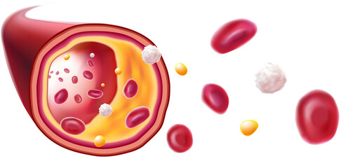 3D Illustration of red blood cells, white blood cells and cholesterol clogging the cause of death. medical use science, education