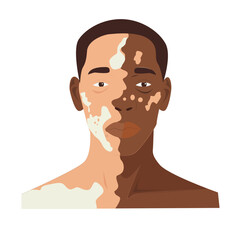 Vitiligo people isolated. Flat vector stock illustration. The concept of different beauty, body positive, self-acceptance. male vitiligo skin disease. Vitiligo skin illustration with people