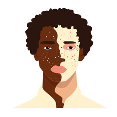 Vitiligo people isolated. Flat vector stock illustration. The concept of different beauty, body positive, self-acceptance. male vitiligo skin disease. Vitiligo skin illustration with people