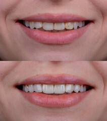 Before and after of smile makeover by dental ceramic veneer, porcelain laminate veneers on front teeth.