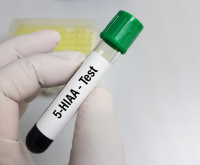 Blood sample for 5-HIAA (5-Hydroxyindoleacetic acid) test, used to help diagnose and monitor carcinoid tumors. Serotonin. Medical test.